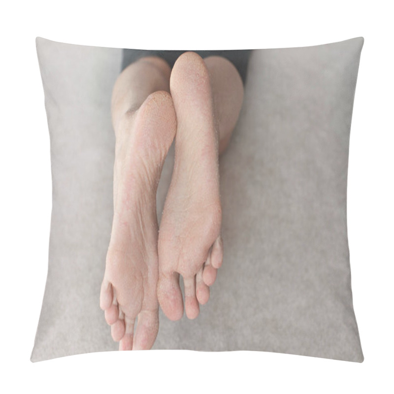 Personality  Close Up Cracked Heels. Health Problems With Skin On Feet Pillow Covers