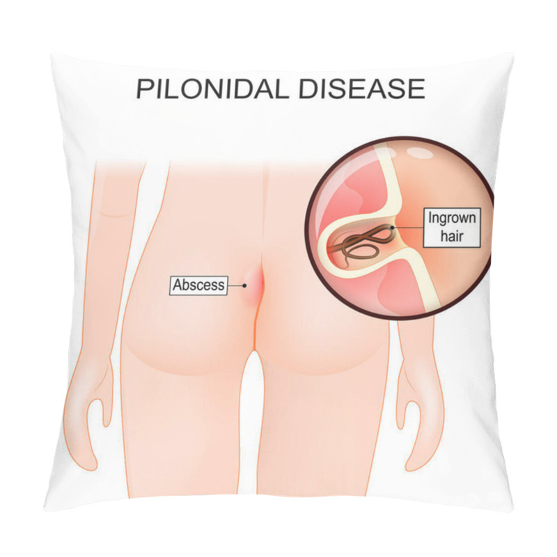 Personality  Pilonidal Disease. Skin Infection. Close-up Of A Cyst With Ingrown Hair Between The Cheeks Of The Buttocks. Pilonidal Cyst, Abscess, Or Fistula. Pilonidal Sinus, Sacrococcygeal Cyst. Vector Illustration  Pillow Covers