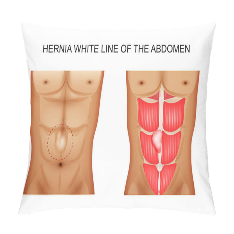 Personality  Hernia White Line Of The Abdomen 2 Pillow Covers