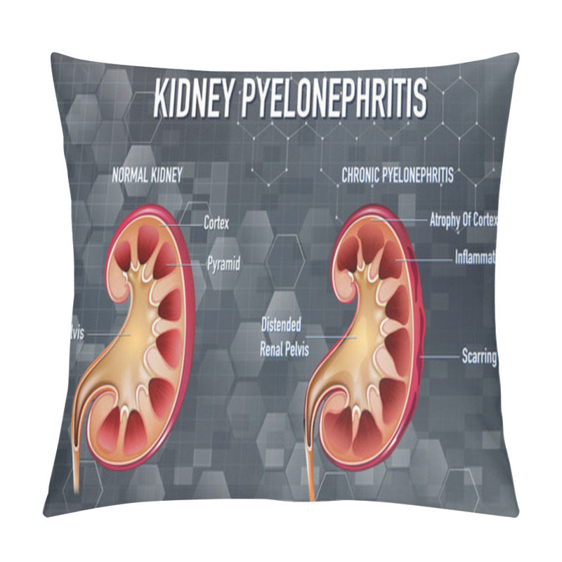 Personality  Informative Illustration Of Pyelonephritis Illustration Pillow Covers