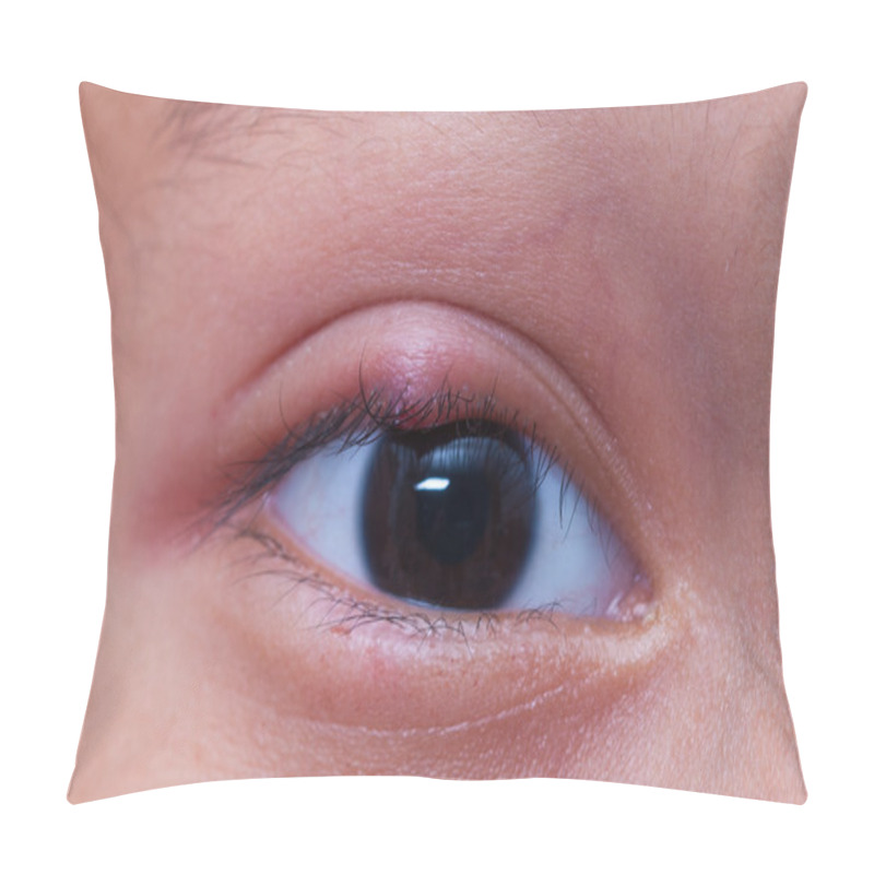 Personality  Close Up Right Upper Eye Lid Abscess, Stye Or Hordeolum Pillow Covers