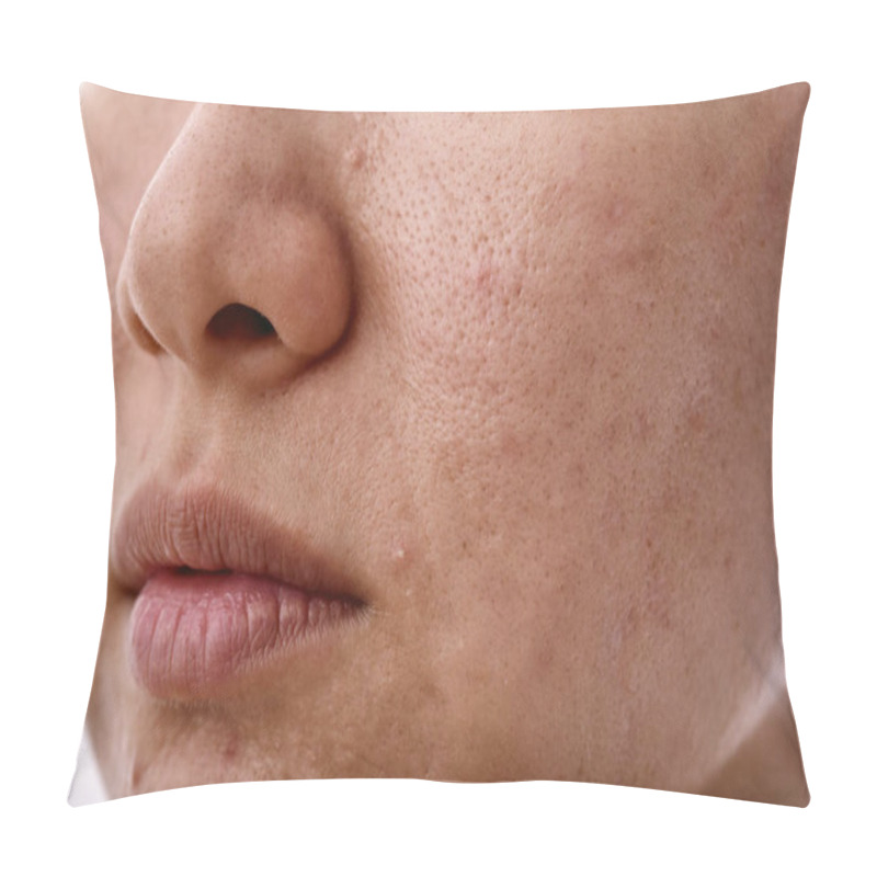 Personality  Skin Problem With Acne Diseases, Close Up Woman Face With Whitehead Pimples On Mouth, Scar And Oily Greasy Face, Beauty Concept. Pillow Covers