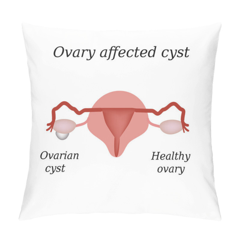 Personality  A Cyst In The Ovary. Pelvic Organs. Vector Illustration On Isolated Background Pillow Covers