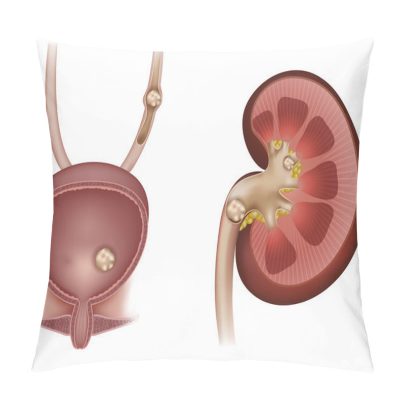 Personality  Stones In The Kidney, Urinary Bladder And Ureter Pillow Covers