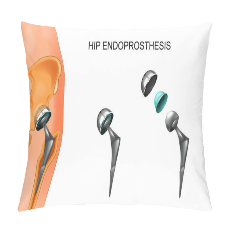 Personality  Vector Illustration Of Female Hip And Hip Prosthesis. Surgery. Pillow Covers