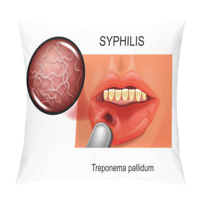 Personality  Vector Illustration Of Syphilis. Chancre. Treponema Pallidum Pillow Covers