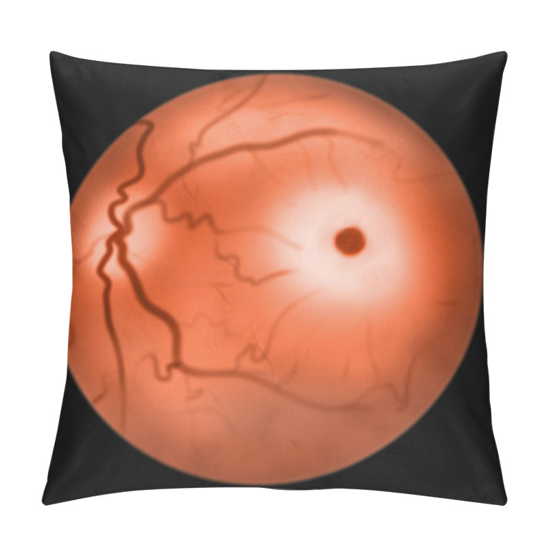 Personality  Eye Retina In Sphingolipid Storage Diseases, 3D Illustration. Macular Cherry Red Spot. Tay-Sachs Disease And Niemann Pick Disease Pillow Covers