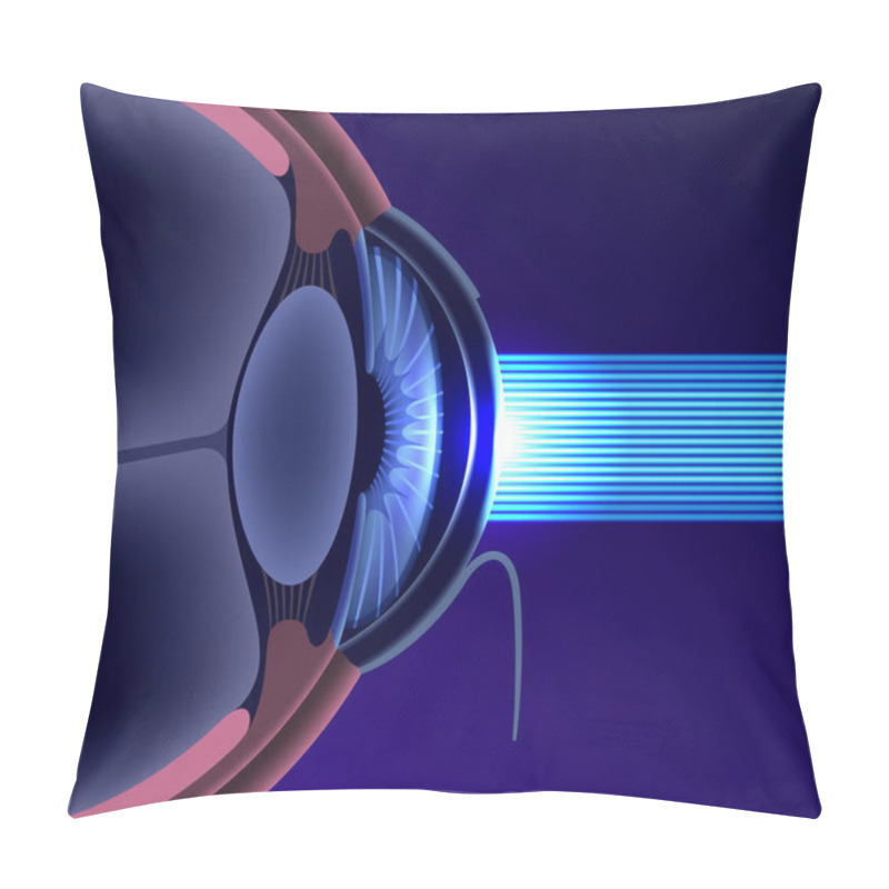 Personality  LASIK Laser Eye Surgery Poster. Correction Of Vision Issues Nearsightedness, Farsightedness, Astigmatism. Safe Painless Procedure, Reshapes Cornea, Human Eye Anatomical 3D Vector Medical Illustration Pillow Covers