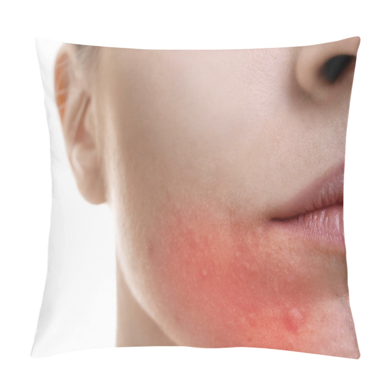 Personality  Skin Care Concept. Young Woman With Acne, Closeup Pillow Covers