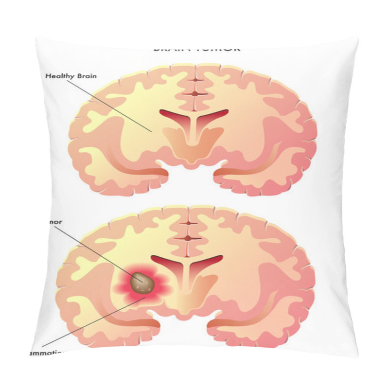 Personality  Brain Tumor Pillow Covers