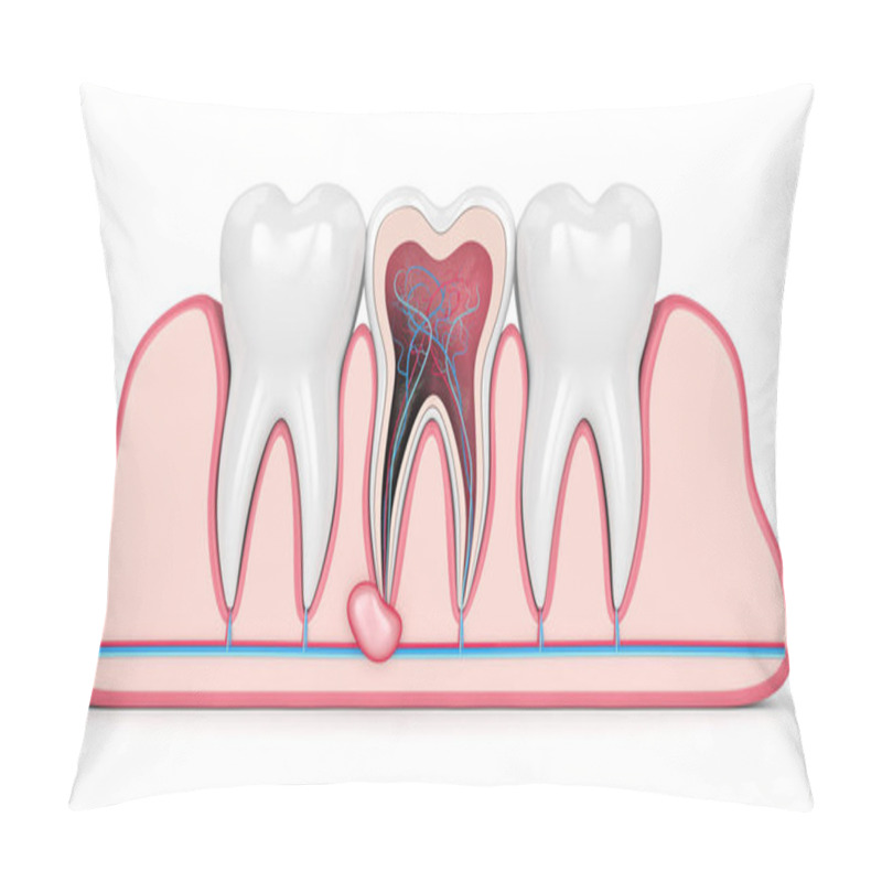 Personality  3d Render Of Teeth In Gums With Cyst Pillow Covers