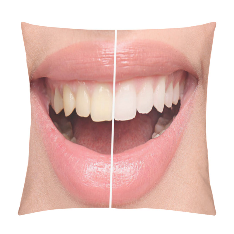 Personality  Smiling Woman Before And After Teeth Whitening Procedure, Closeup Pillow Covers