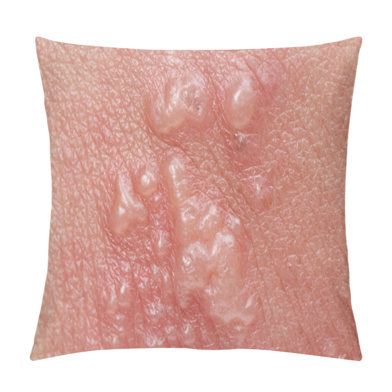 Personality  Shingles, Zoster Or Herpes Zoster Symptoms On Arm Pillow Covers