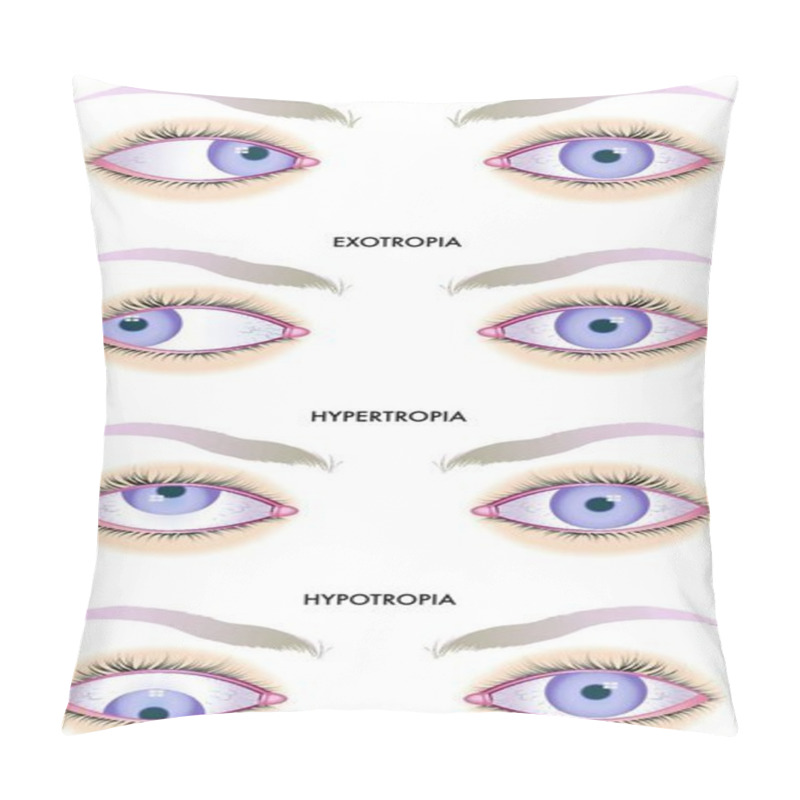 Personality  Medical Illustration Of The Effects Of The Strabismus Pillow Covers