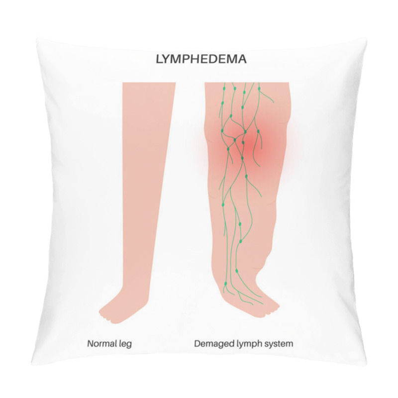 Personality  Lymphedema Disease Concept. Swelling Of Female Legs Or Arms. Damaged Lymph Nodes In Human Obesity Body. Overweight Problem And Elephantiasis. Disorder In The Lymphatic System Flat Vector Illustration. Pillow Covers