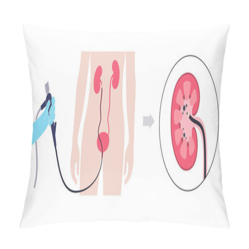 Personality  Ureteroscopy Is A Minimally Invasive Procedure. Examination And Treatment Of The Kidney. Disorder Of The Urinary System, Cancer, Polyps, Stones Or Inflammation. Poster Of Urinary Tract Medical Vector Pillow Covers