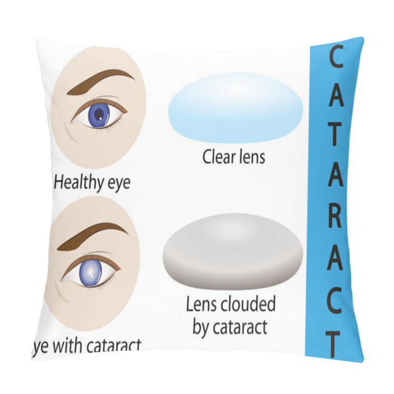 Personality  A Cataract Is An Clouding Crystalline Lens Inside The Eye. Pillow Covers