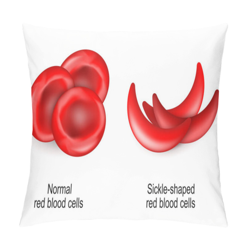 Personality  Sickle Cell Disease. SCD Is A Blood Disorder Inherited From A Person's Parents. Sickle Cell Anaemia. Comparison And Difference Between Normal Erythrocytes And Sickle-shaped Red Blood Cells. Vector Illustration Pillow Covers