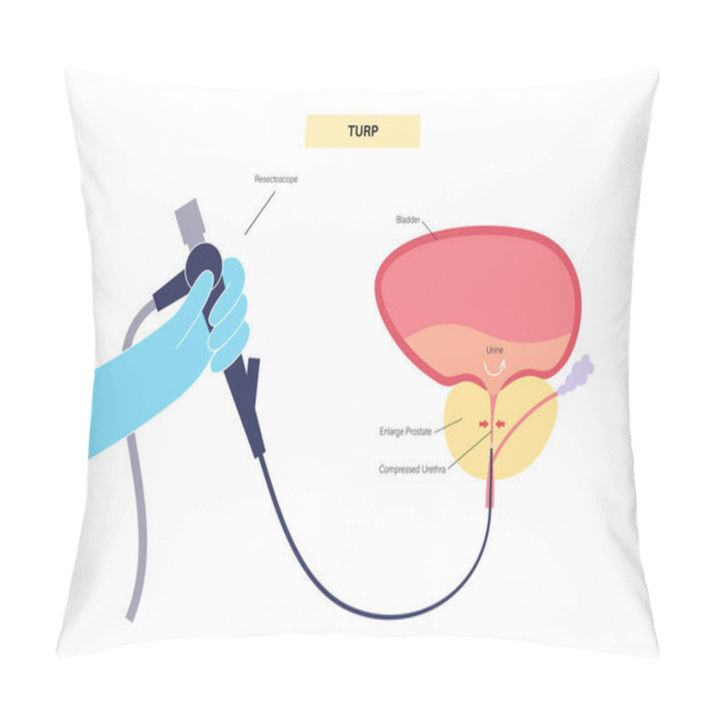 Personality  Transurethral Resection Of The Prostate. TURP Medical Procedure. Surgical Removal Of Part Of The Prostate Gland. BPH Treatment Medical Poster. Anatomical Medical Poster Of Bladder Vector Illustration Pillow Covers