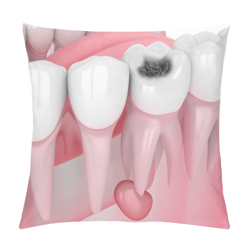 Personality  3d Render Of Jaw With Tooth Cavity And Cyst Pillow Covers