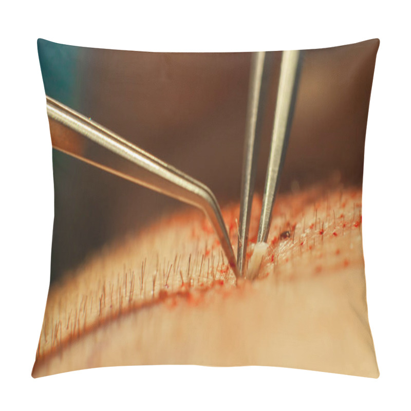 Personality  Macrophotography Of A Hair Bulb Transplanted Into A Hairless Area. Baldness Treatment. Hair Transplant. Surgeons In The Operating Room Carry Out Hair Transplant Surgery. Surgical Technique That Moves Pillow Covers