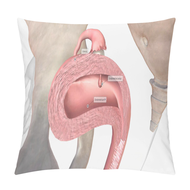 Personality  Endometrial Polyps Are Abnormal Growths Of The Inner Lining Of The Uterus, Known As The Endometrium. 3D Rendering Pillow Covers