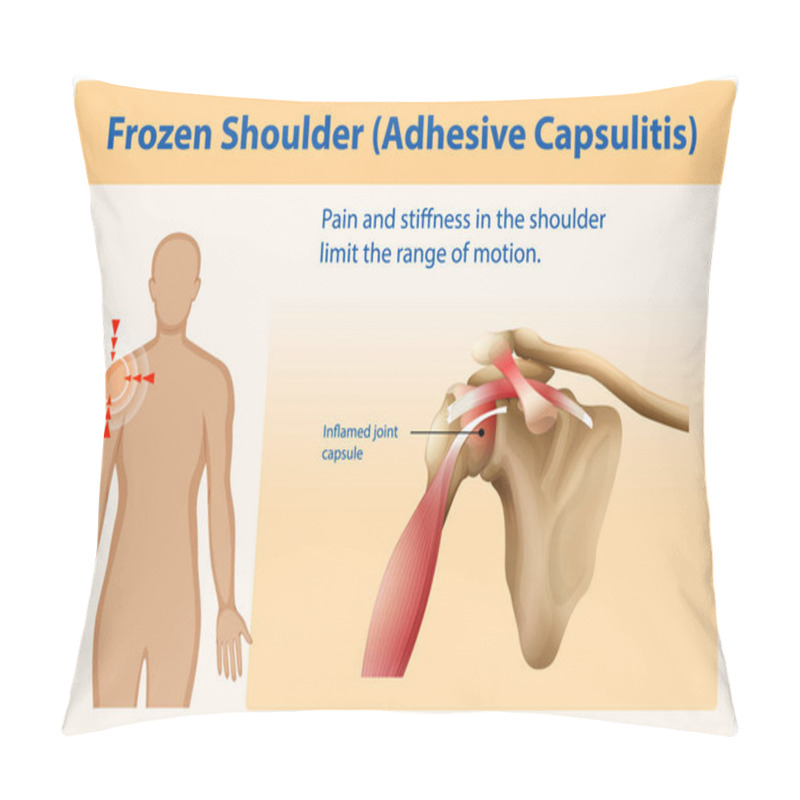 Personality  Illustration Of Shoulder Pain And Inflammation Causes Pillow Covers