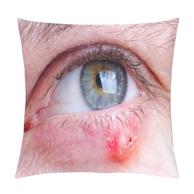 Personality  Stye (hordeolum) Disease On Eye Of A Caucasian Female Pillow Covers