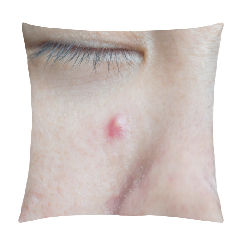 Personality  The Infected Pustulous Acne On Fac Pillow Covers