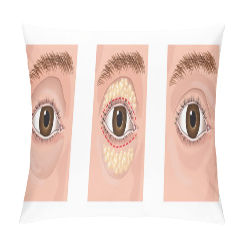 Personality  Blepharoplasty Pillow Covers