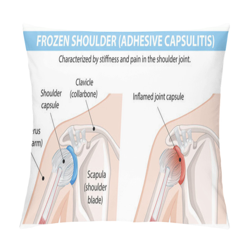 Personality  Diagram Showing Frozen Shoulder Condition And Anatomy Pillow Covers