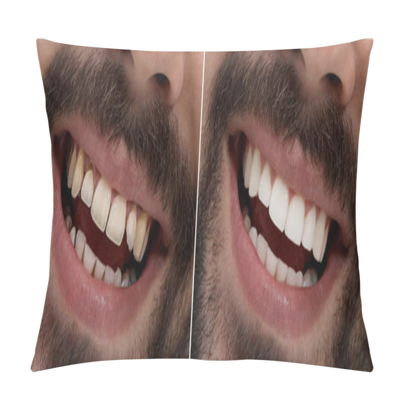 Personality  Collage With Photos Of Young Man Before And After Dental Treatment, Closeup. Banner Design Pillow Covers