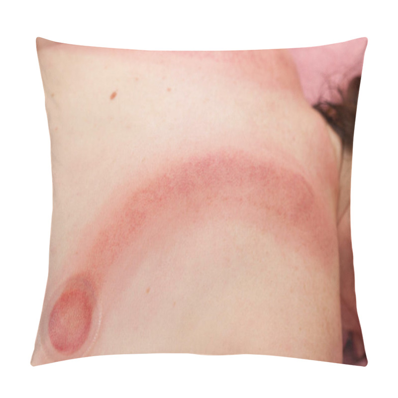 Personality  Human Back, Receiving Vacuum Cupping Massage Pillow Covers