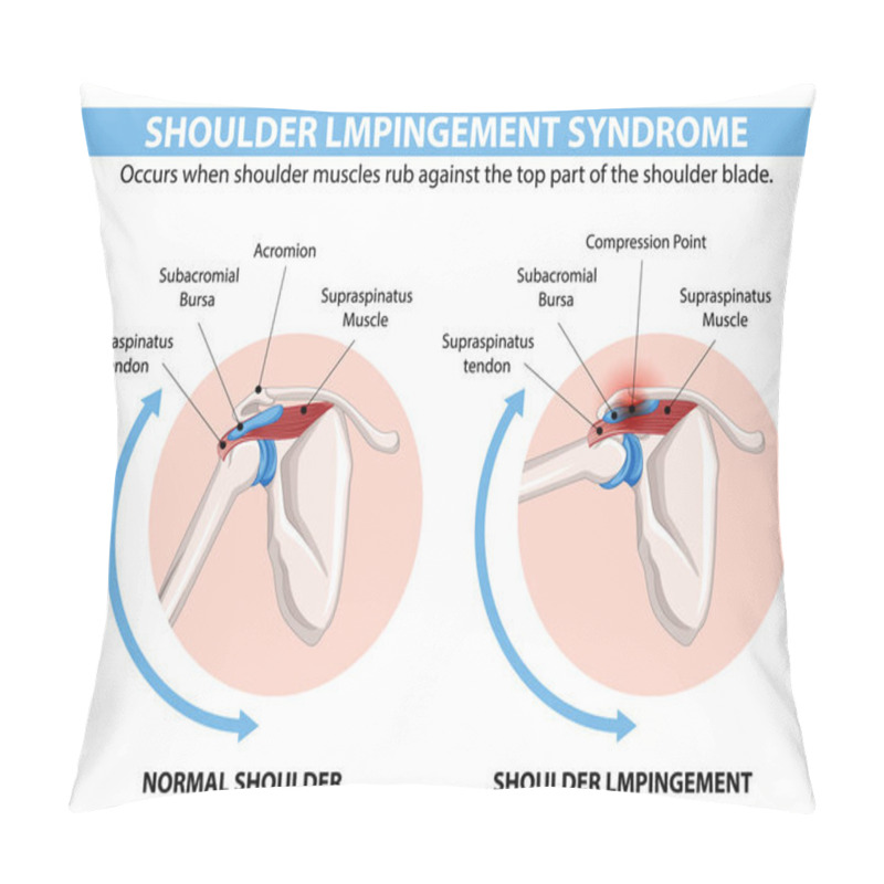 Personality  Comparison Of Normal Shoulder And Shoulder Impingement Pillow Covers