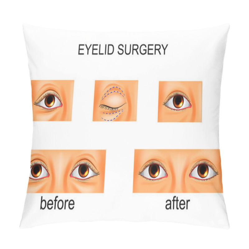 Personality  Eyelid Surgery, Plastic Surgery Pillow Covers