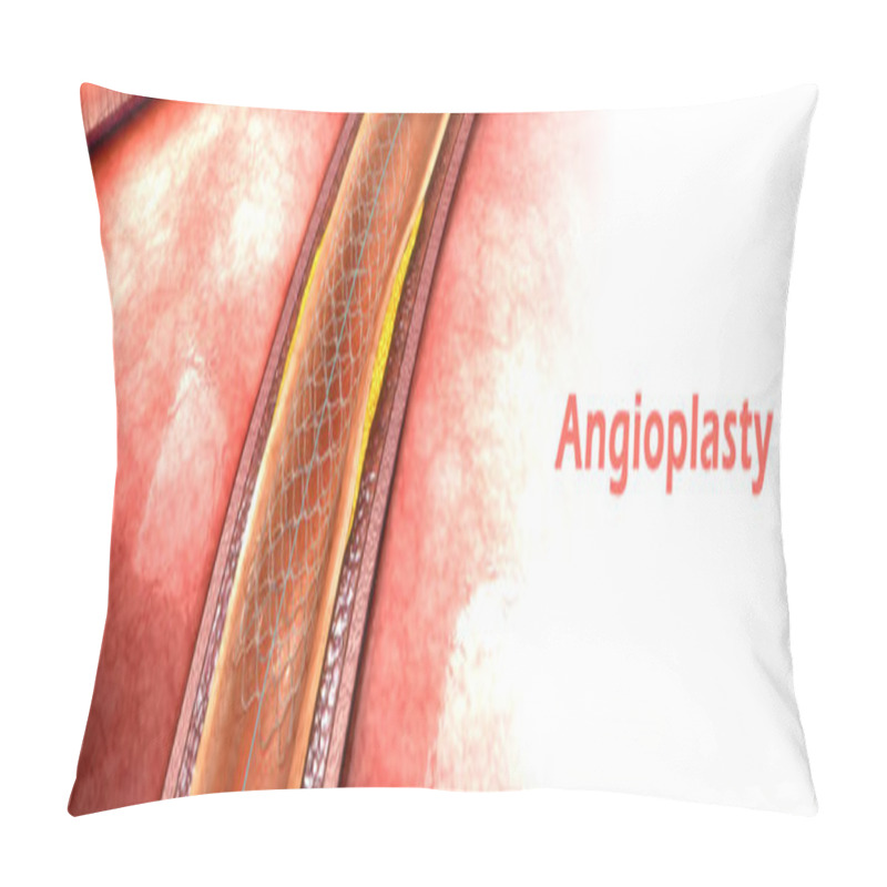 Personality  Coronary Angioplasty 3d Pillow Covers