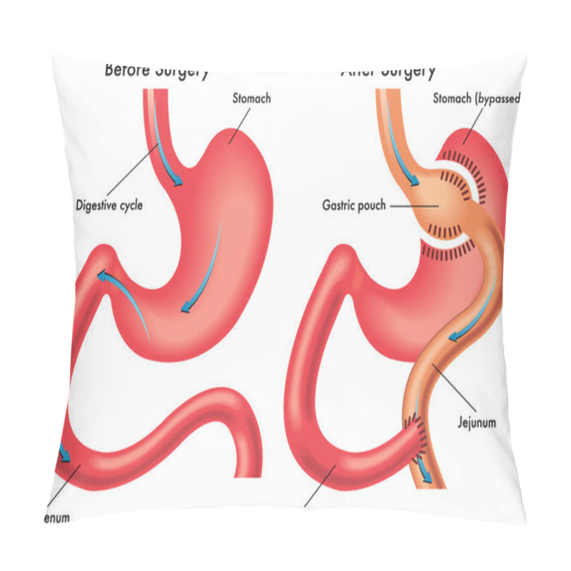 Personality  Gastric Bypass Pillow Covers