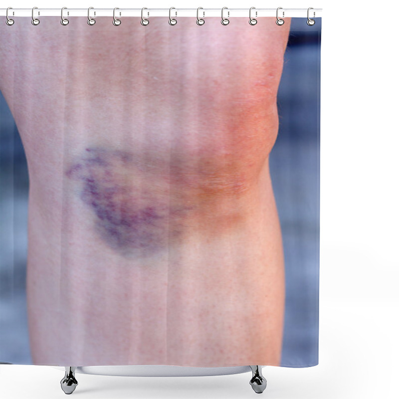 Personality  Hematoma Shower Curtains