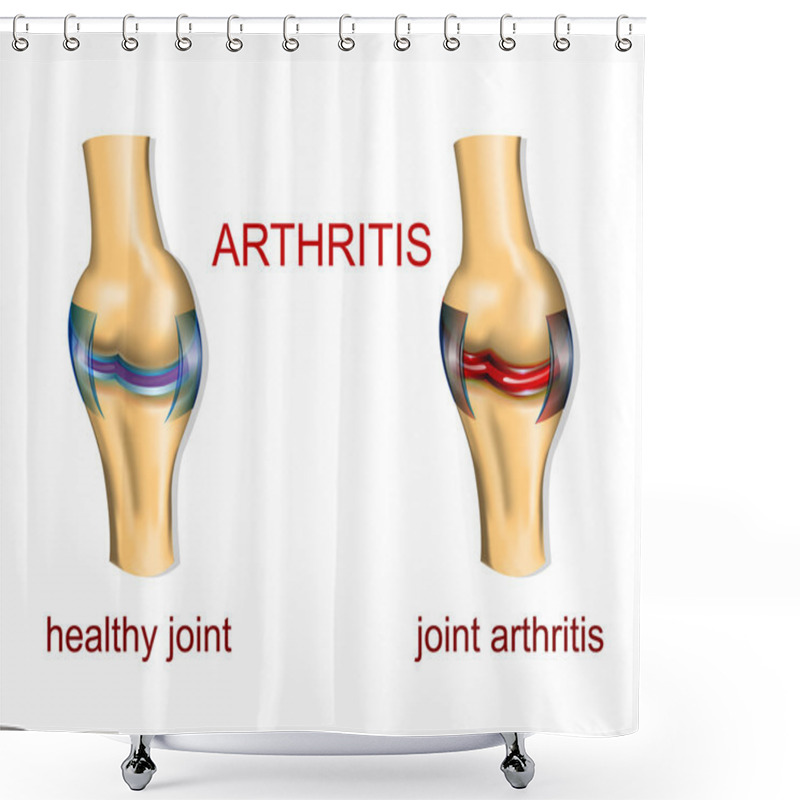 Personality  JOINT ARTHRITIS Shower Curtains