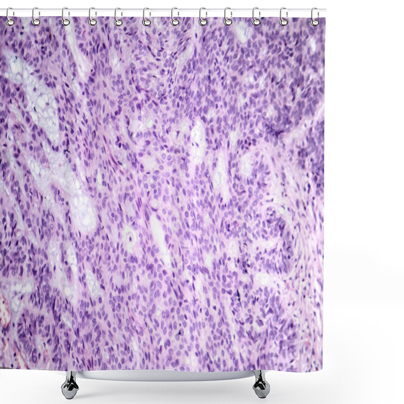 Personality  Photomicrograph Of Basal Cell Carcinoma, Displaying Malignant Basal Cells Typical Of The Most Common Skin Cancer. Shower Curtains