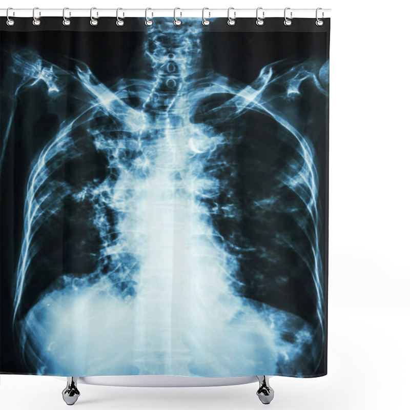 Personality  Pulmonary Tuberculosis . Film Chest X-ray Of Old Patient Show Interstitial Infiltration Both Lung And Calcification At Trachea ( Can Seen Shape Of Trachea ) Shower Curtains