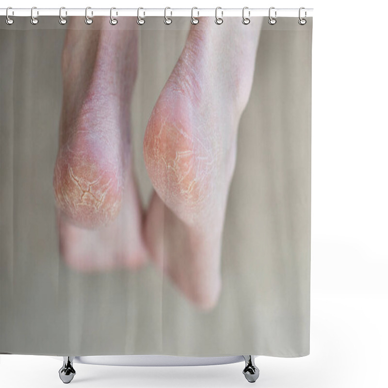 Personality  Close Up Cracked Heels. Health Problems With Skin On Feet Shower Curtains