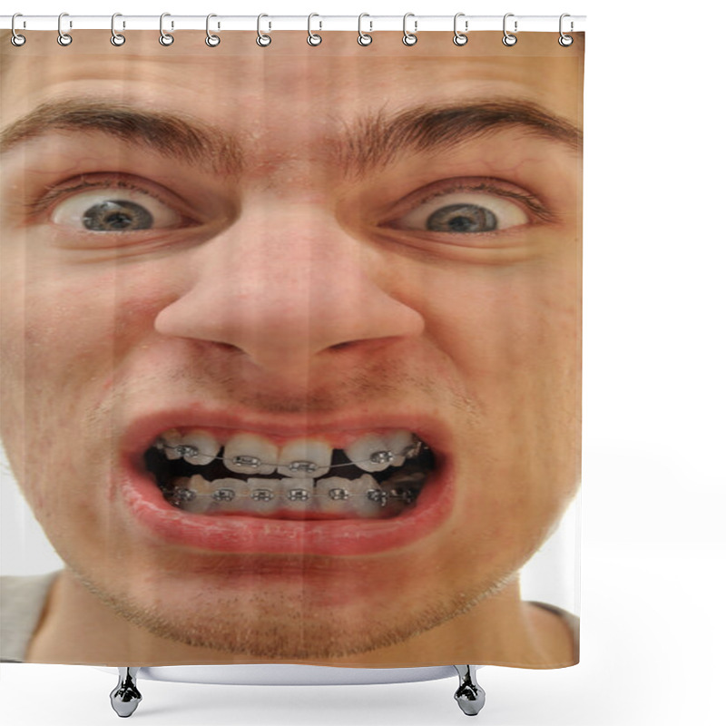 Personality  Young White Causcasian Man Shows Off His New Braces On His Pure White Teeth. Shower Curtains