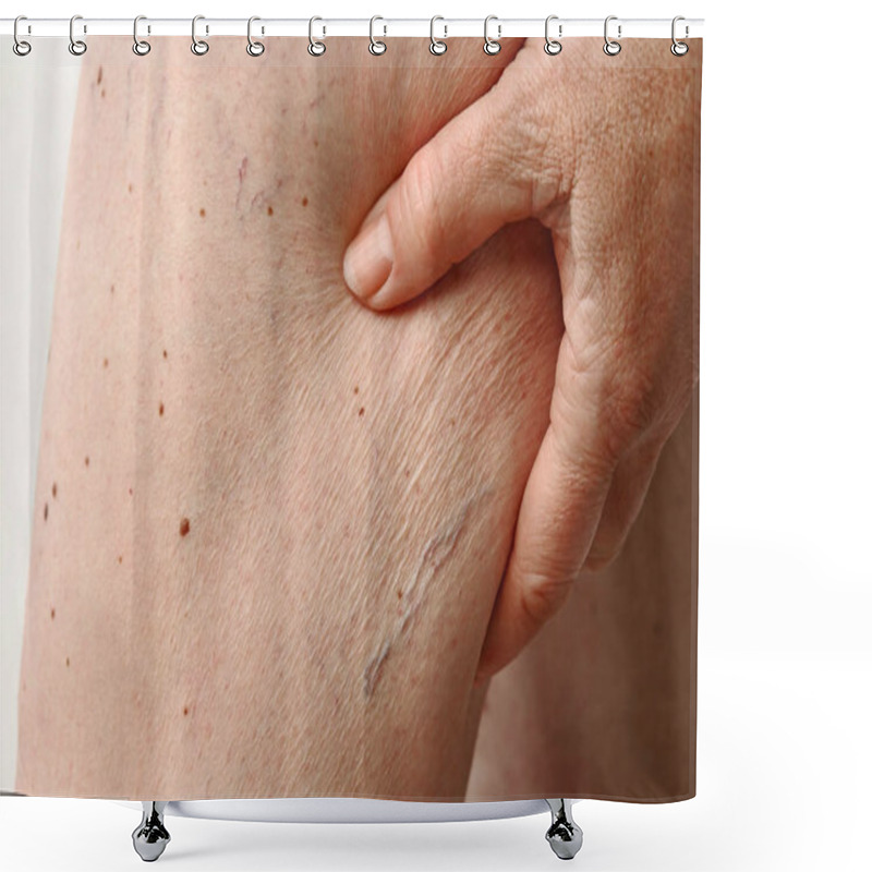 Personality  Spider Veins And Cellulite On A Woman's Leg. Pathological Change In The Leg Shower Curtains