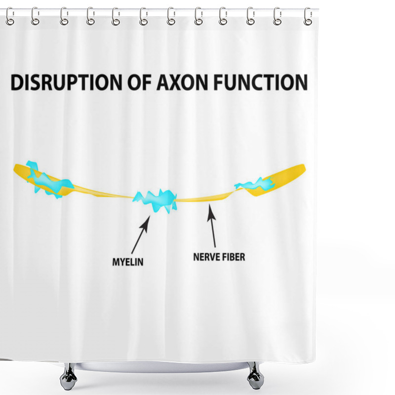 Personality  The Destruction Of The Myelin Sheath On The Axon. Damaged Myelin. Neuron Affected By Multiple Sclerosis. World Multiple Sclerosis Day. Infographics. Vector Illustration On Isolated Background. Shower Curtains