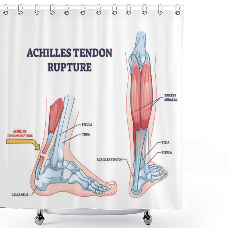 Personality  Achilles Tendon Rupture As Painful Injury And Leg Trauma Outline Diagram. Labeled Educational Anatomical Scheme With Orthopedic Problem Explanation Vector Illustration. Medical Body Muscle Condition. Shower Curtains