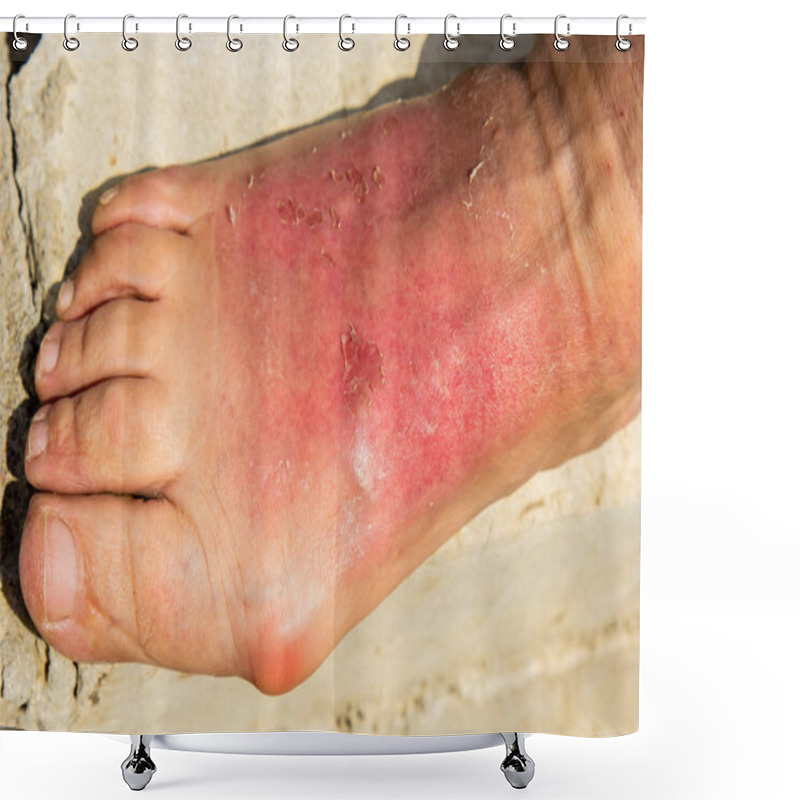 Personality  As A Result Of A Skin Burn, The Woman's Leg Was Swollen In The Ankle Region. Dermatitis, Expressed By Redness, Peeling, And Soreness After Sunbathing. Sore Foot Bump. Shower Curtains