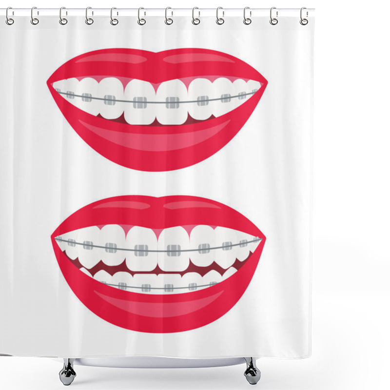 Personality  Dental Braces. Smile With Braces On The Teeth. Alignment Of Bite Of Teeth, Correct Bite Of Teeth. Dental Jaw With Braces. Vector Illustration On White Background Shower Curtains