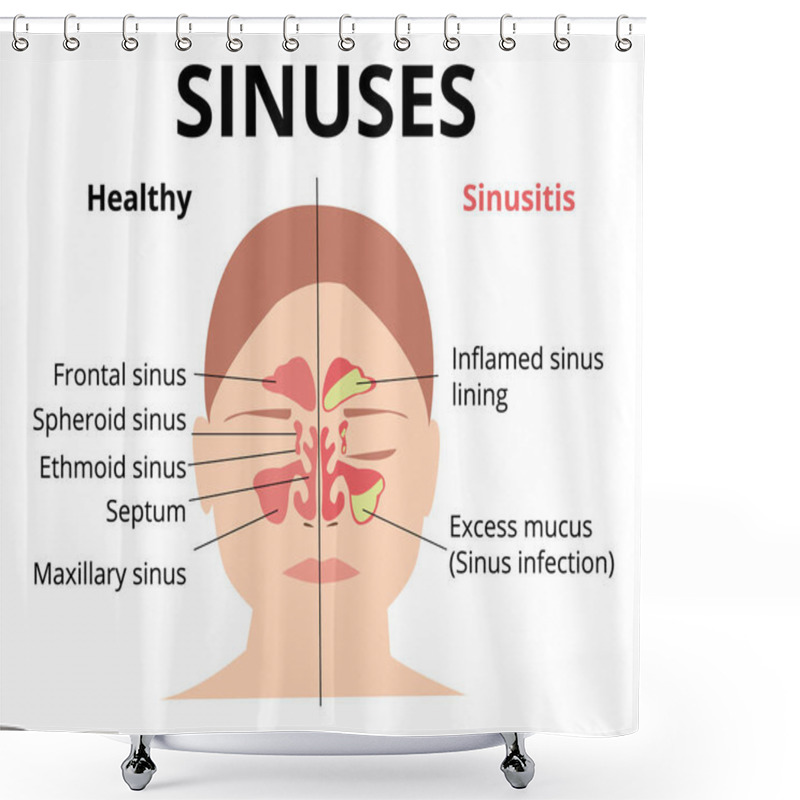 Personality  Sinusitis Medical Treatment. Nasal Sinus. Healthy And Inflammation Sinus. Nasal Diseases. Sinusitis, Sinus Infection Diagnosis  Medical Infographic Design. Otolaryngology Concept. Isolated On White Shower Curtains