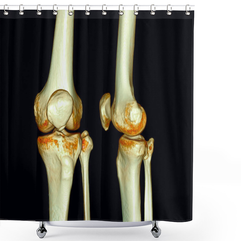 Personality  CT Scan Of  Knee Joint 3D Rendering . Shower Curtains